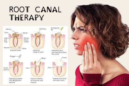 Root Canal Dental Treatment Chicago